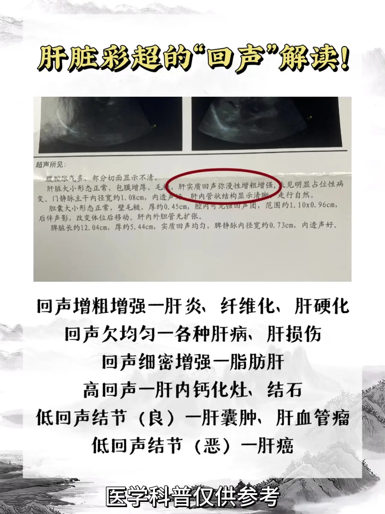 彩超 医学科普 山东 肝病