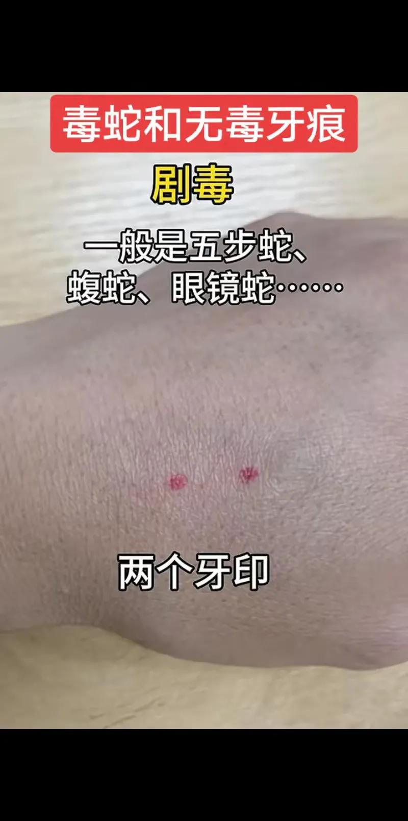 有网友爆料说，有毒蛇和无毒蛇咬人的伤口是不一样的，有毒蛇咬的伤口一般为两个红点，