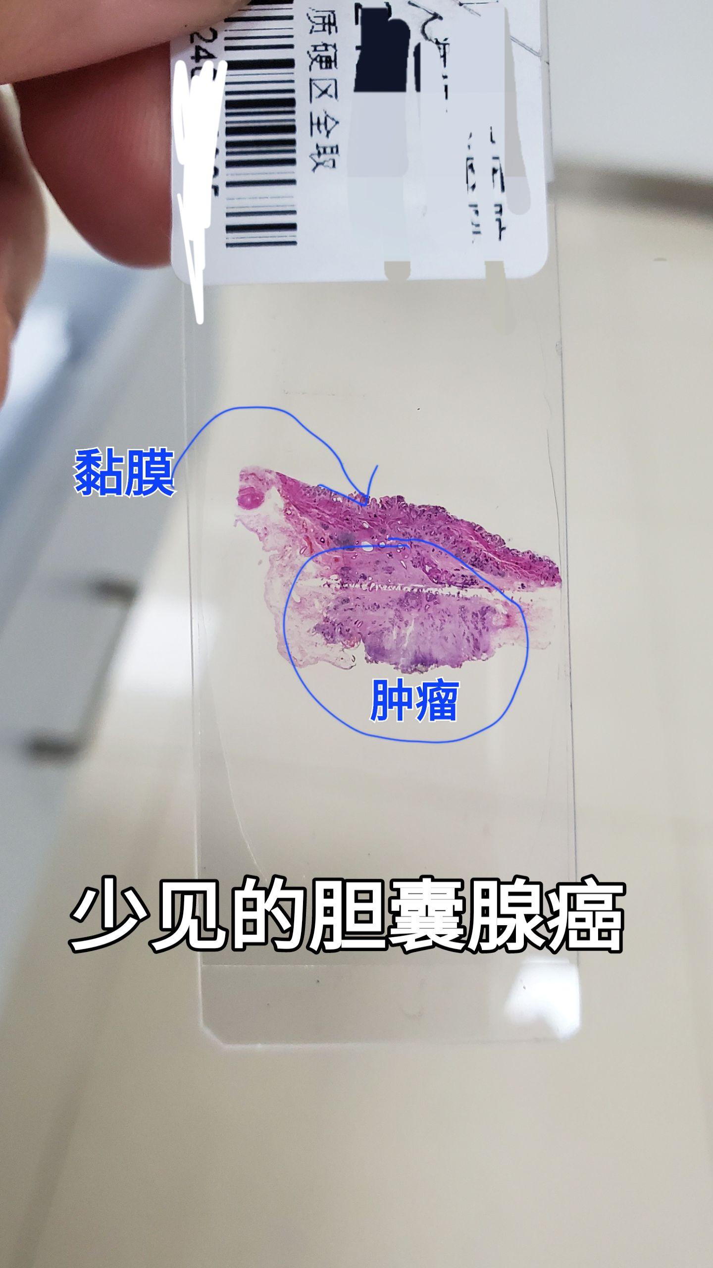 胆囊腺癌