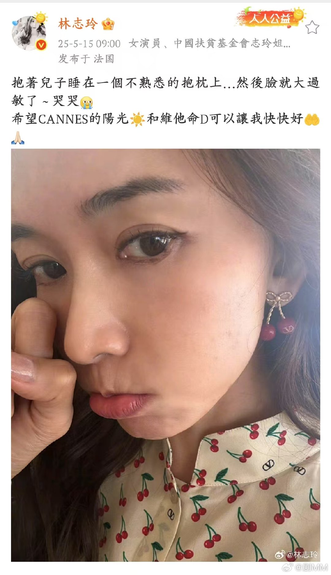 林志玲的脸大过敏 好心疼，谁能想到睡个觉还能让志玲姐姐遭遇过敏困扰，愿阳光和维 