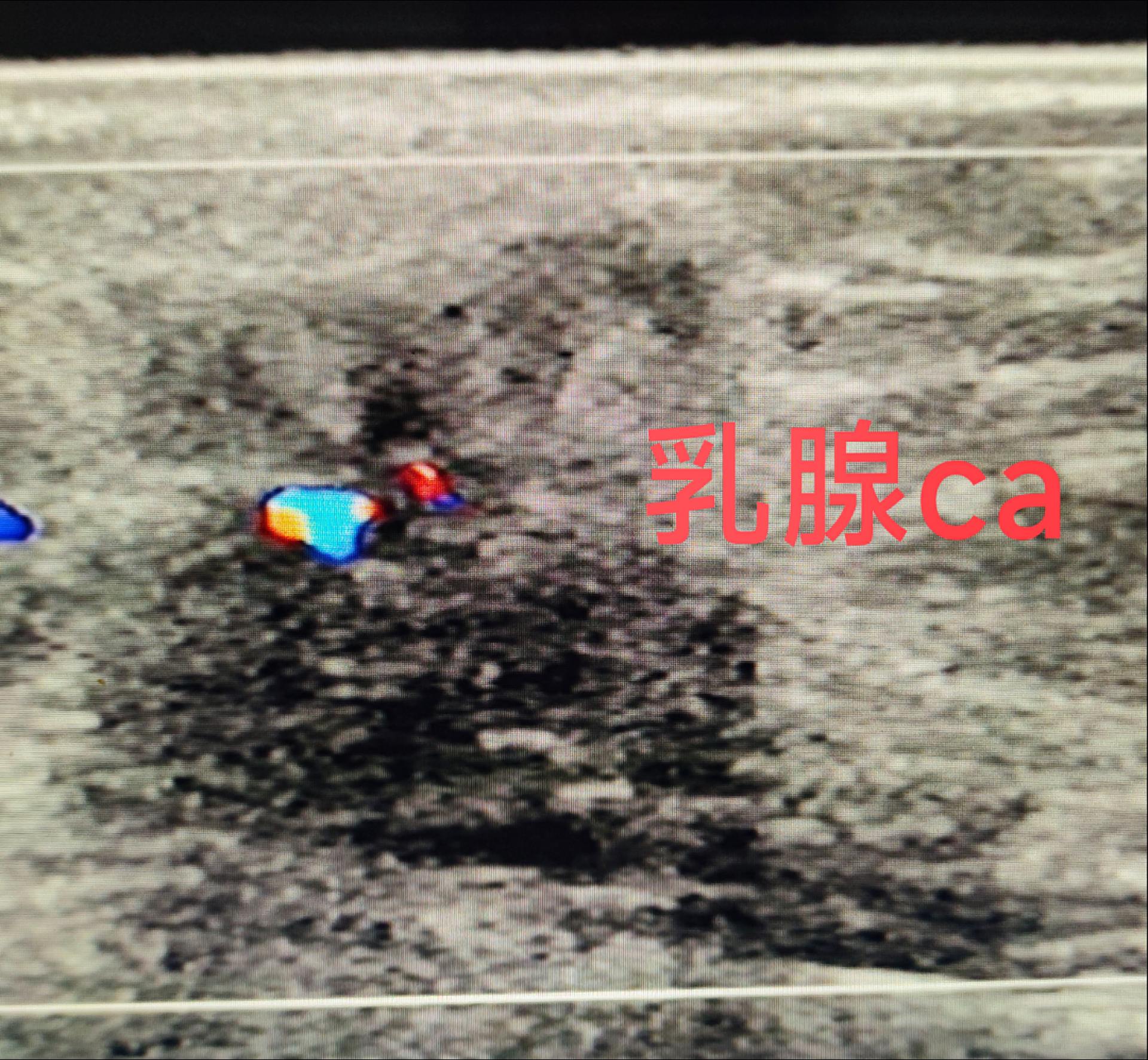 乳腺ca.浅筋膜浅层中断