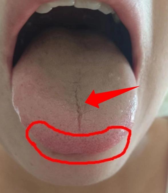 男人欲望强不强，看看舌尖就知道了！这种舌头该说不说，挺难调[泣不成声]

舌中裂