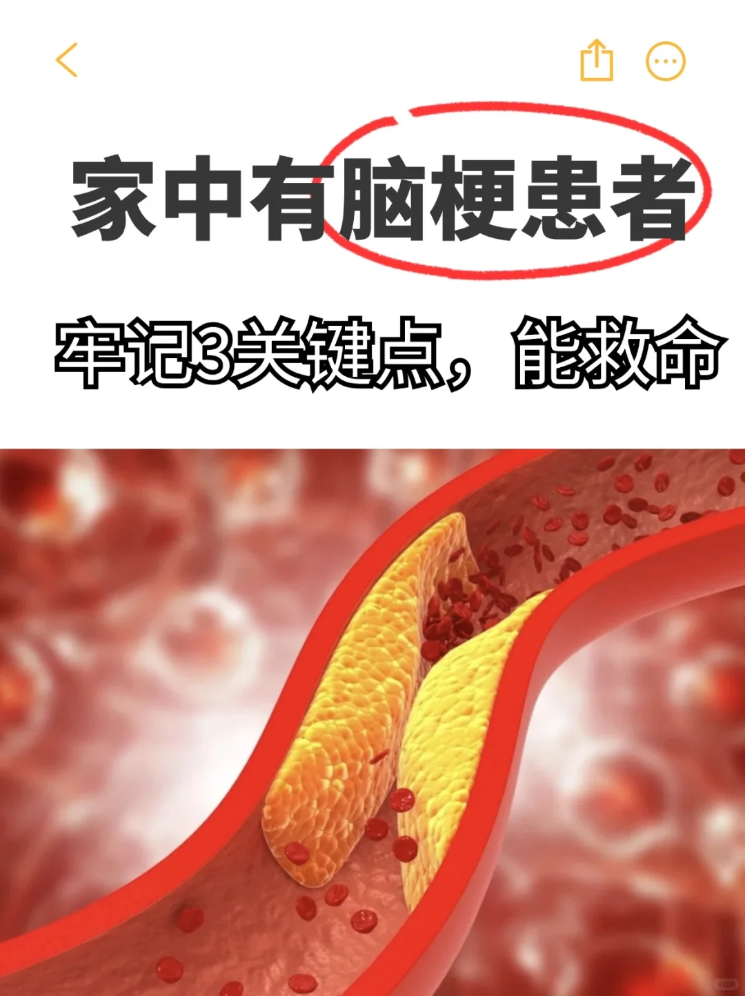 家中有脑梗患者，牢记3关键点，能救命 家中有脑梗患者，了解以下三个关键...