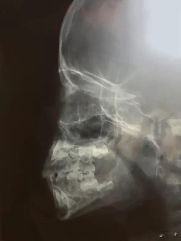 女孩做正颌手术反成鞋拔子脸 女孩做正颌手术，结果成了鞋拔子脸，这事儿可太闹心了。