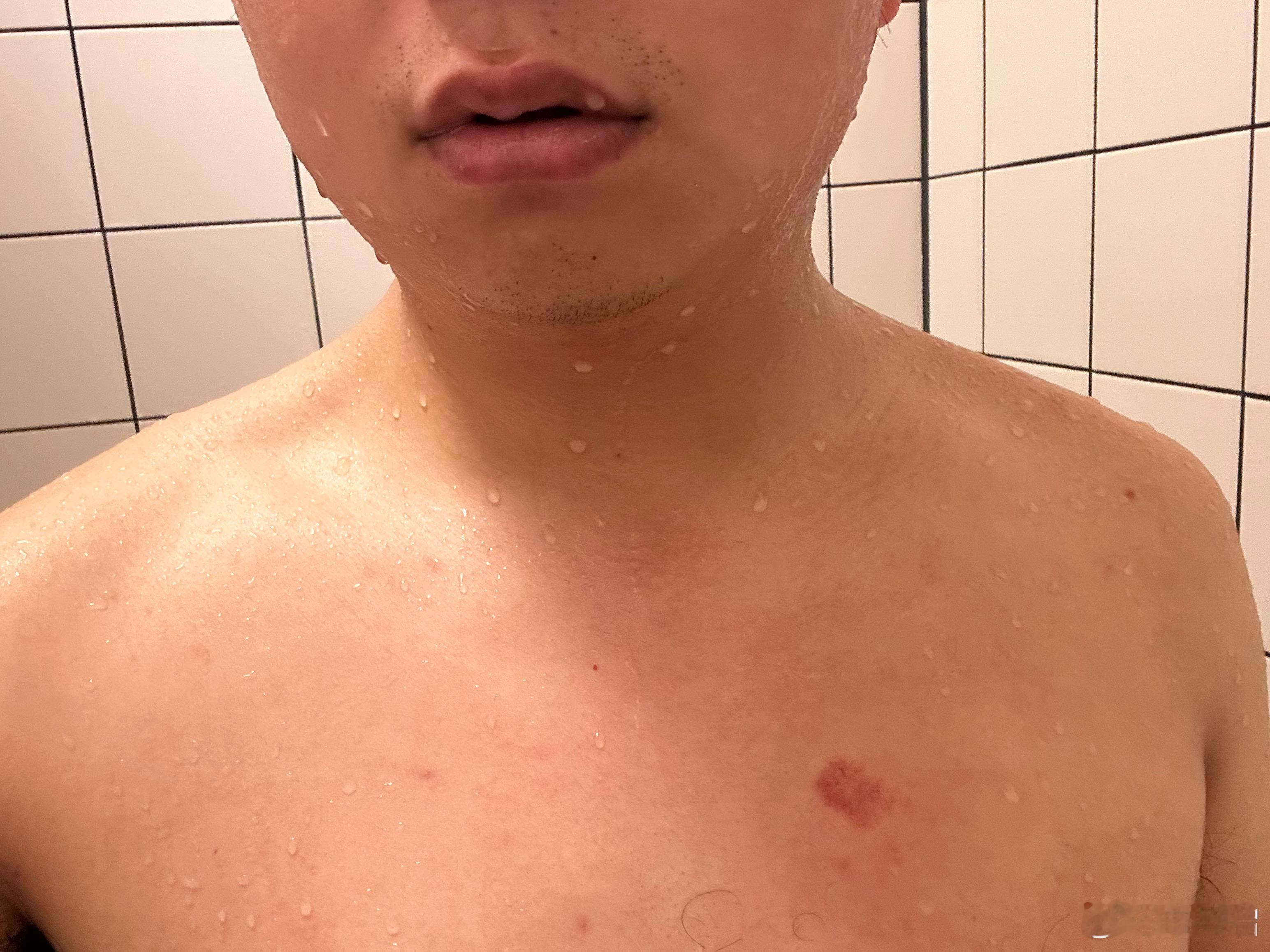 最近我胸口好像被撞伤了，莫名其妙出现一个淤青。  ​​​