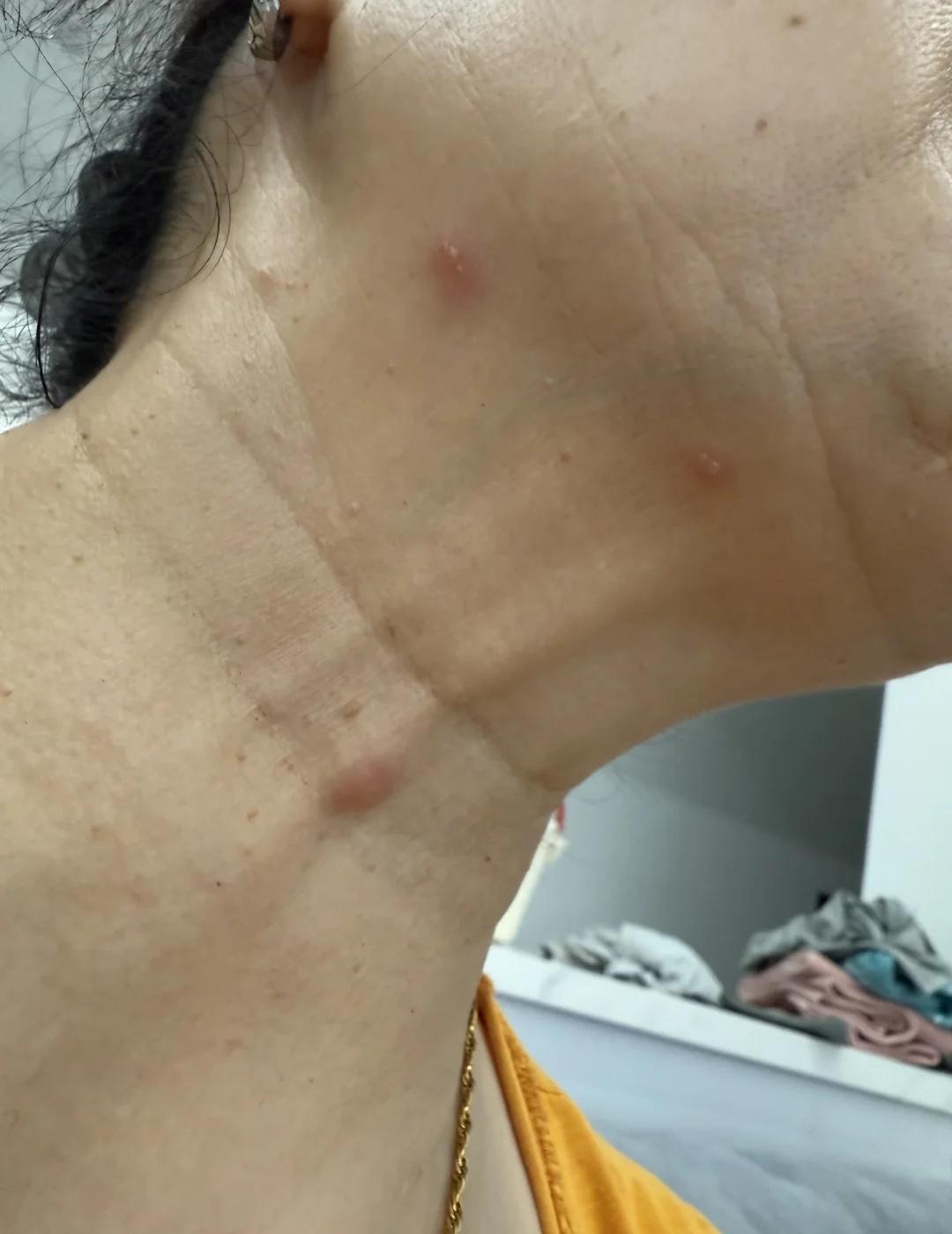 这是啥虫子咬的
不痒也不痛，有水泡身上起红点点