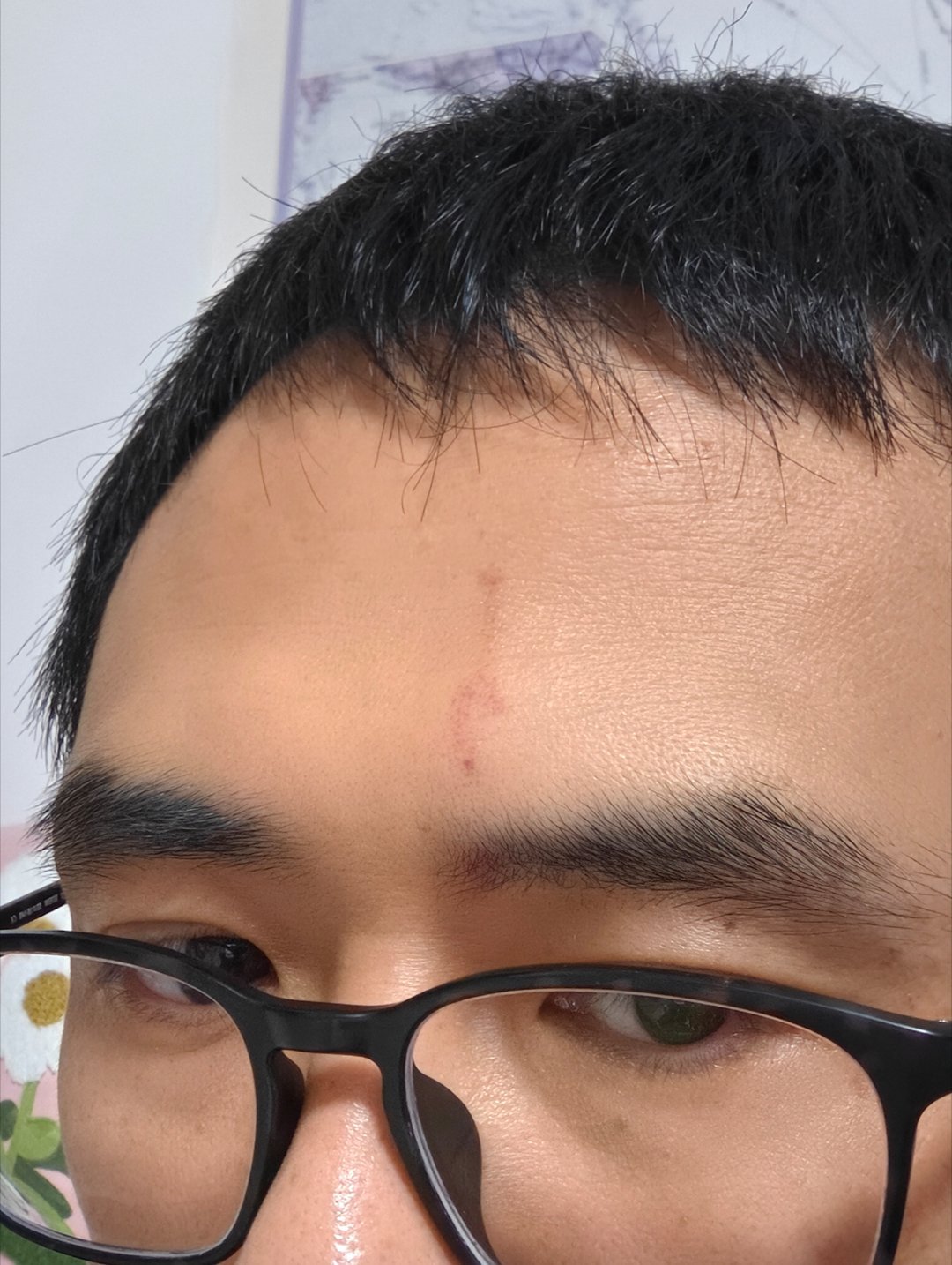 今天被球擦到头[二哈]没想到还留下印了眼镜被打飞，镜片也掉出来了，好在镜腿没断 