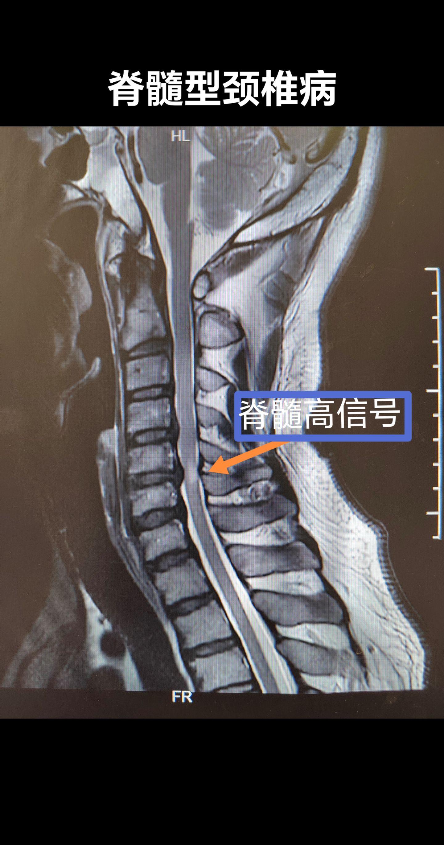 脊髓型颈椎病。 这位病人来的还是晚了一些，受压迫的脊髓已经发生了变性...