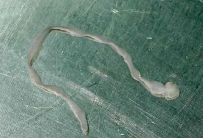 广东梅州惊魂！女子脑中揪出8厘米活虫，竟因生蛙腿塞牙“钓虫”偏方，这些危险行为你