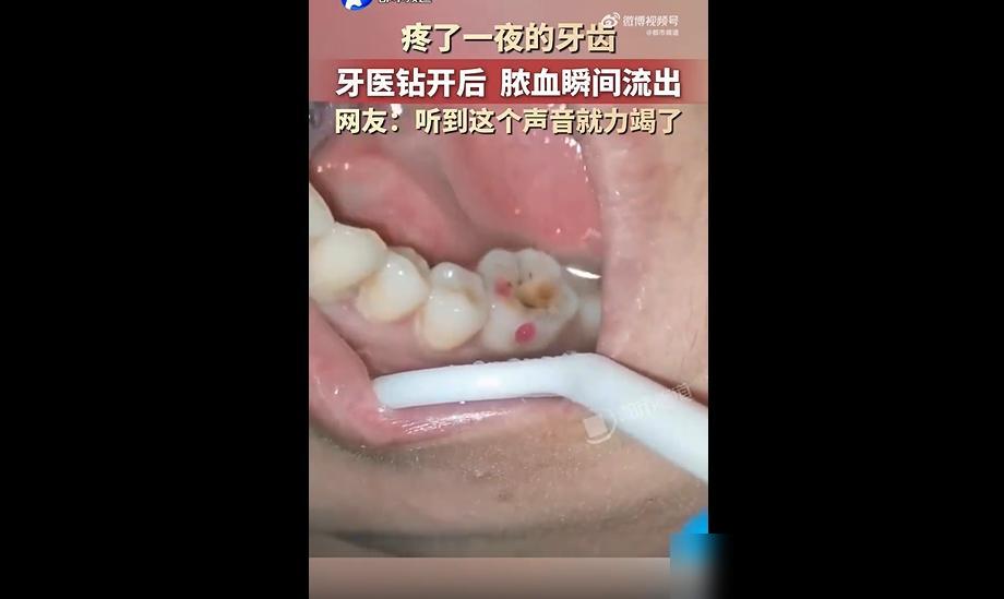 牙疼绝对是最磨人的小病痛！

我前两年就踩过同款大坑，半夜后槽牙跳着疼，整宿翻来