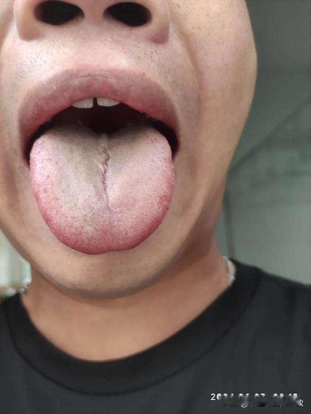 裂纹舌千万别大意，拖得越久，肾伤的就越狠，非常难缠[发怒][发怒][发怒]
门诊