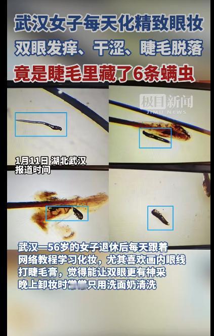 有位武汉的刘阿姨因为眼睛又痒又干、睫毛总掉，跑去医院一查，结果把医生都吓了一跳她