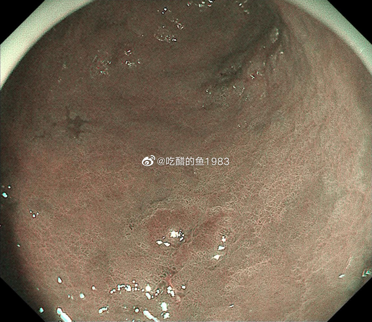 东北的一对姐妹，一位有活检是癌，在沈阳超声什么都做了先在的外科就诊建议外科手术，