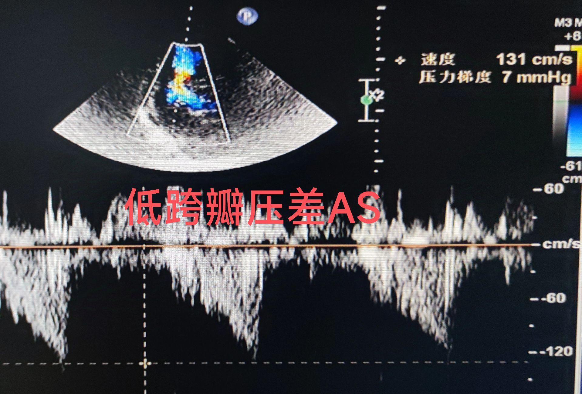 低跨瓣压差主动脉瓣狭窄超声。二维及M型在心脏超声是基础 需要综合判断 ...