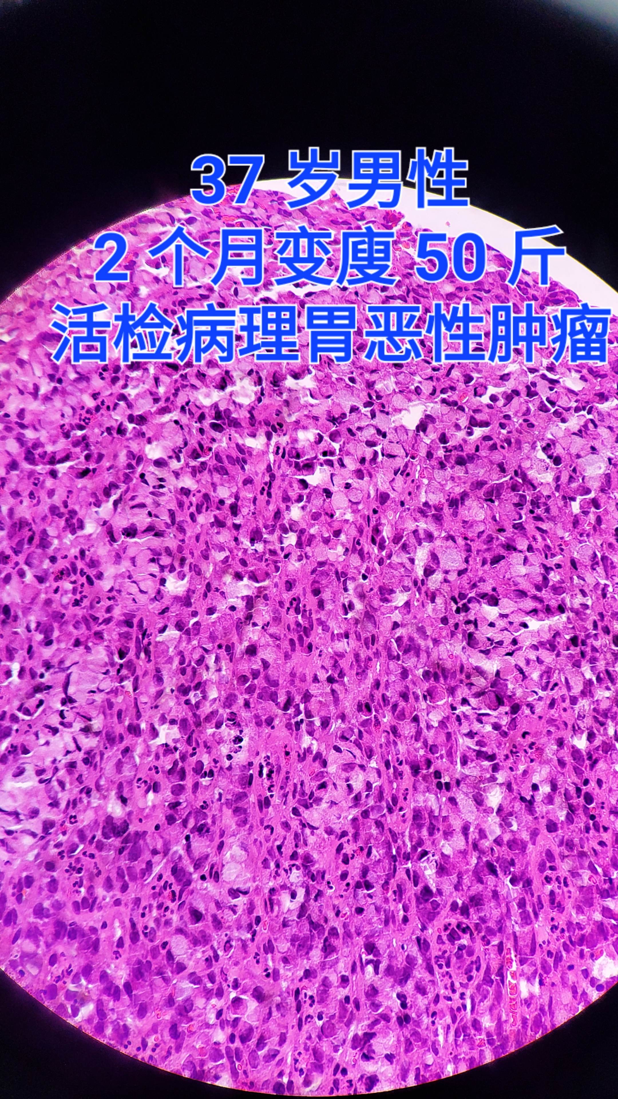 印戒细胞癌 年轻人也要注意自己的身体，食品卫生要注意