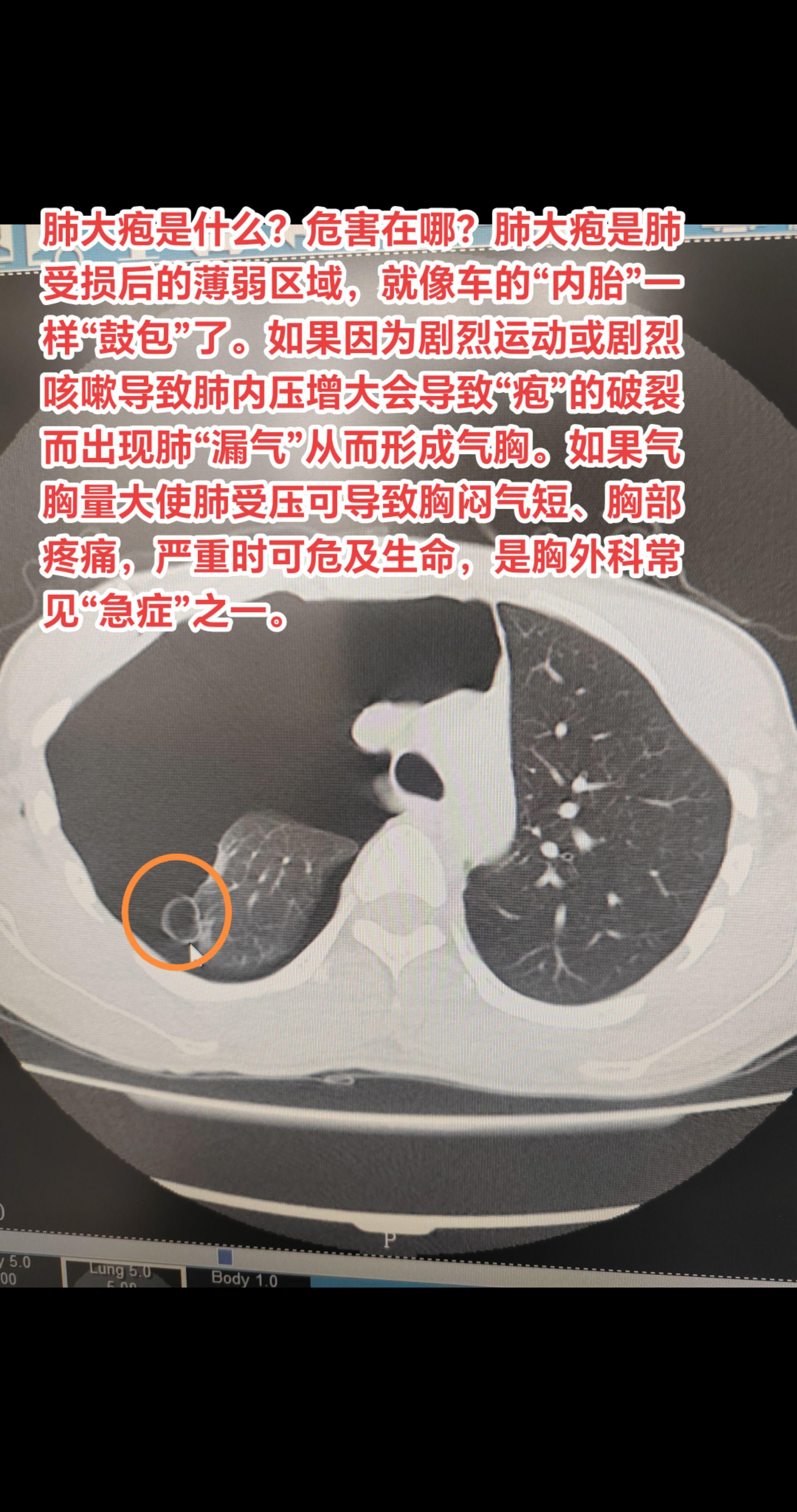 肺大疱是什么？危害在哪？肺大疱是肺受损后的薄弱区域，就像车的“内胎”一...