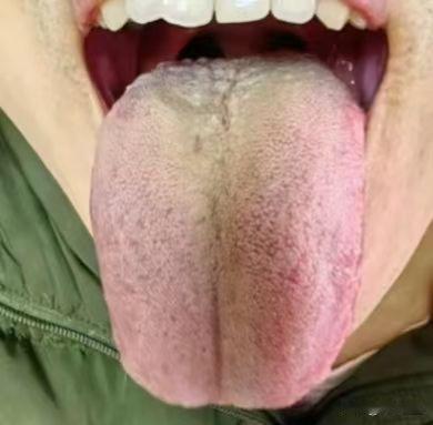 【舌诊分析】不看看自己舌根烂成啥了，还想着吃六味地黄丸补肾？补啥都没用！
这是我