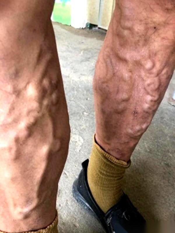 杭州46岁的黄先生光着身子站在花洒下，手里的搓澡巾正对着右腿的小腿肚狠命发力。下