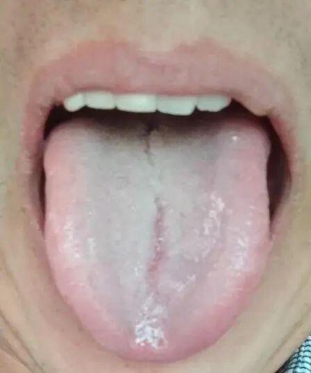 舌象之谜：裂纹中隐藏的不只是脾肾两虚
针对某些舌象，尽管中根部出现裂纹，但这并不