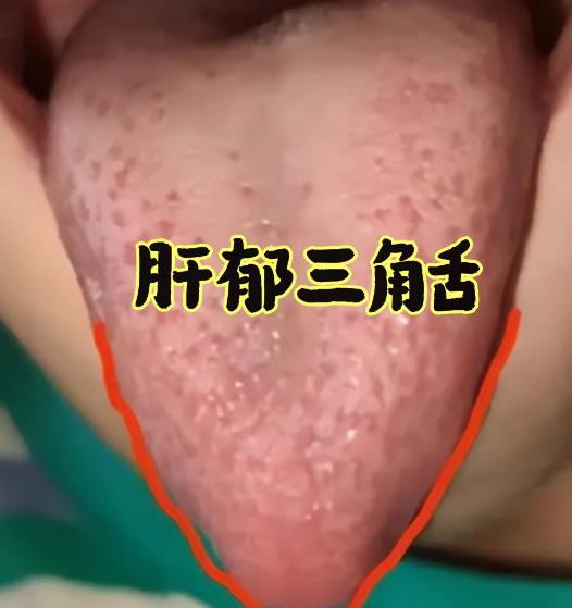 舌头倒三角——肝郁，舌下筋脉粗紫——血瘀，舌尖发红——心火旺，舌红少苔——阴虚火