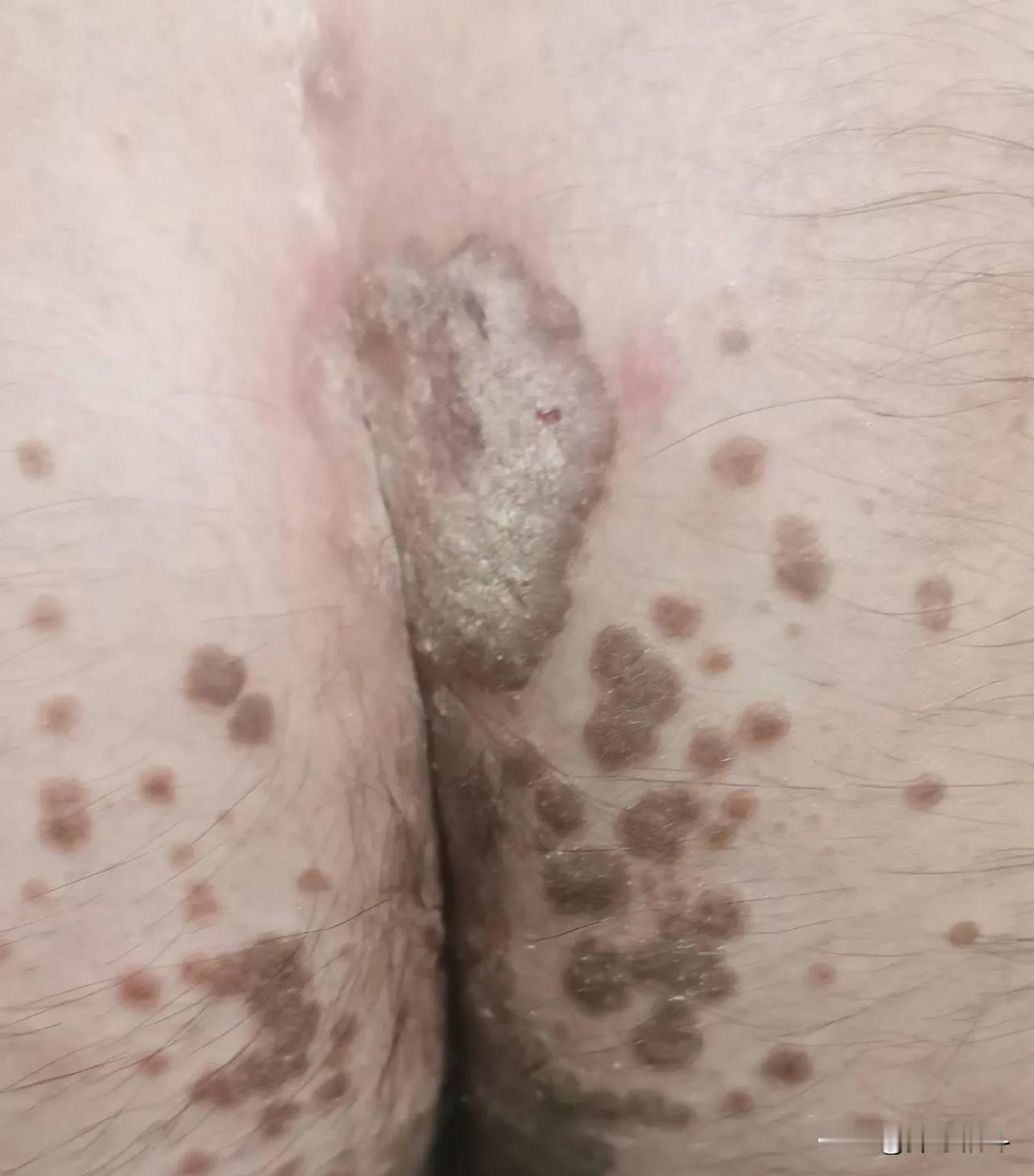 有没有打过疫苗后身上有这样情况的，或者知道这是什么情况的请留言。症状是痒，这些点