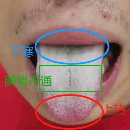 前几天挑战1000个舌象的病例中，遇到了一个典型的上热下寒舌象，拿来讲讲

舌尖