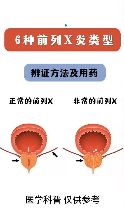6种前列腺炎类型辨证方法以及调理方法！