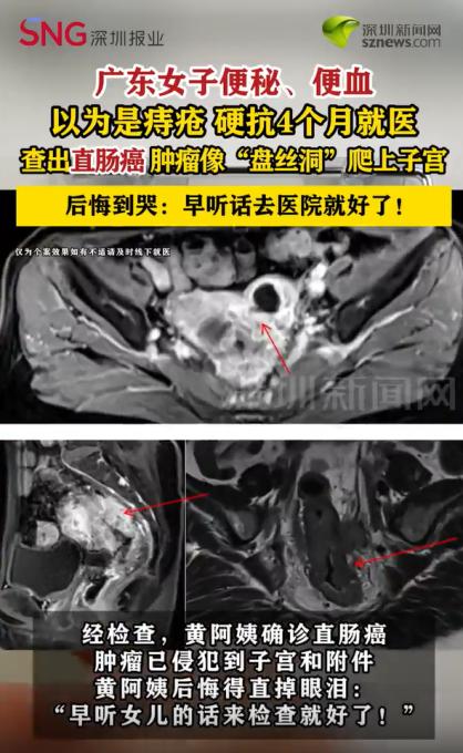 “后悔晚了！”广东一女子硬扛便秘便血4个月，起初以为是痔疮，结果去医院一查：直肠
