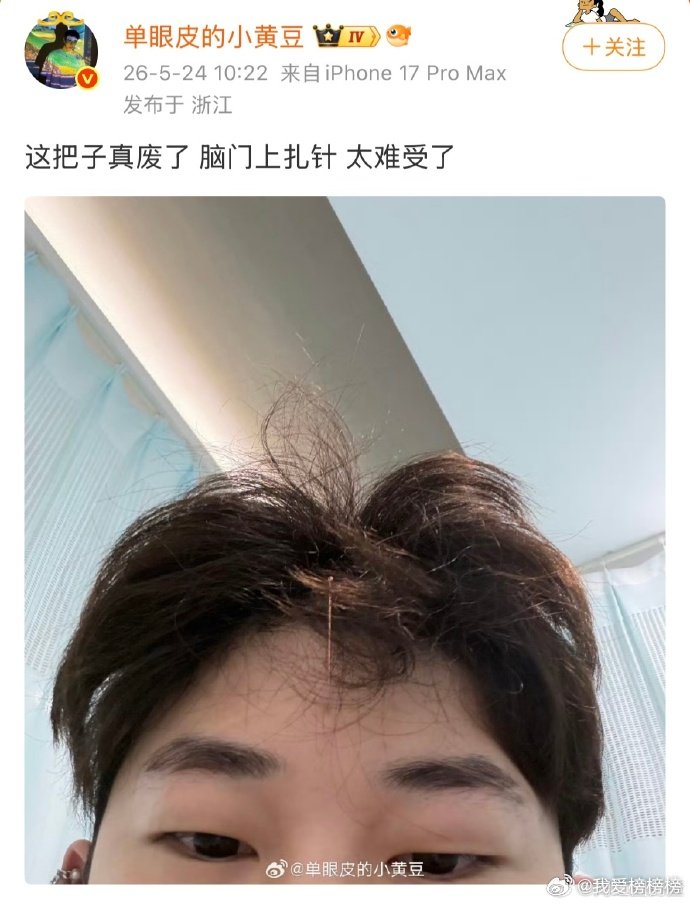 小黄豆颈椎痉挛 脖颈突发病痛牵动网友关注，针灸成为此次调理颈椎痉挛的方式。大家各