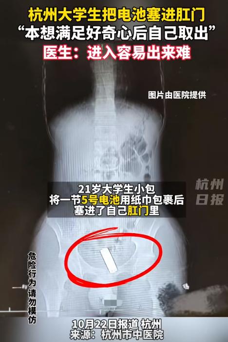 好奇心害死人！杭州，21岁大学生为寻刺激，将一节5号电池用纸巾包裹后，塞进了下体