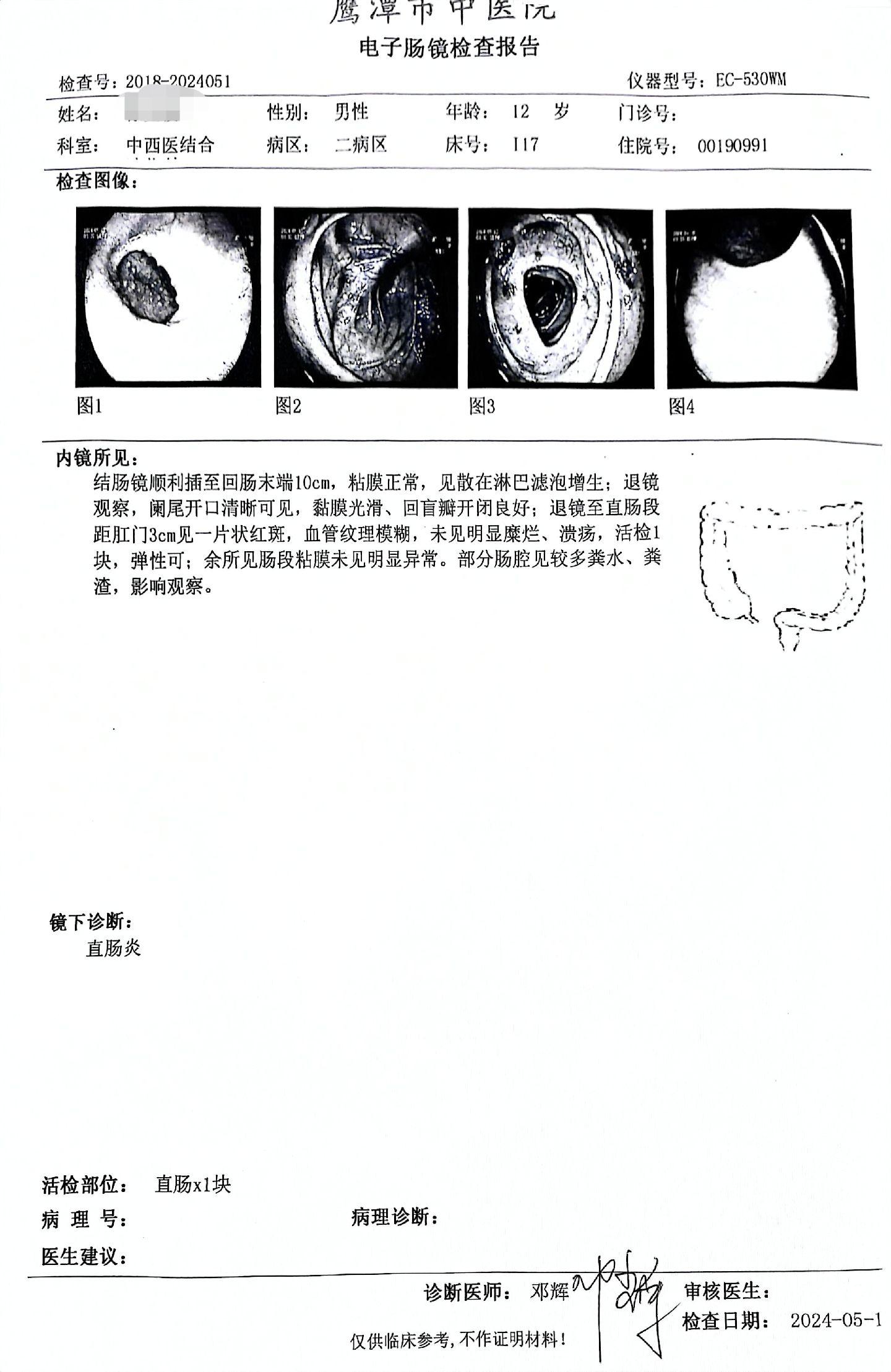 不是报告写着克罗恩病就是克罗恩病。今天炎症性肠病门诊，来了个因为腹痛来看的12岁小朋友，外院疑似上消化道cd，看了觉得依据不足，后来他爸爸说腿上发东西，一看对称性紫癜，考虑腹型过敏性紫癜。请教了薛主任，这个病最常累及十二指肠，翻了一下图谱学习一下。又有了收获。