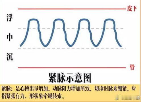 中医脉诊----“紧”脉：紧脉：指脉相来往有力，左右弹人手（《素问》）。《脉诀》