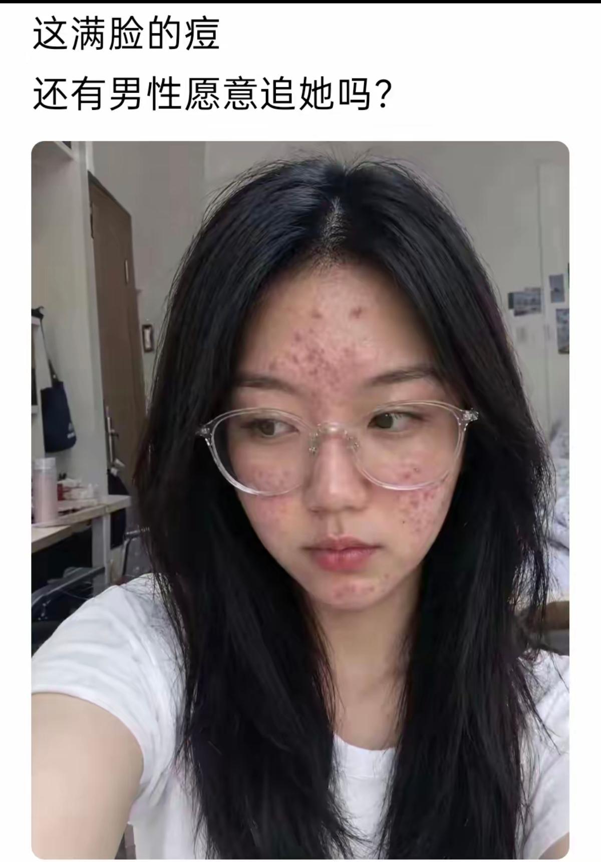 追到她你就偷着乐吧，青春痘恋爱后会好的，美人胚子才是王道。