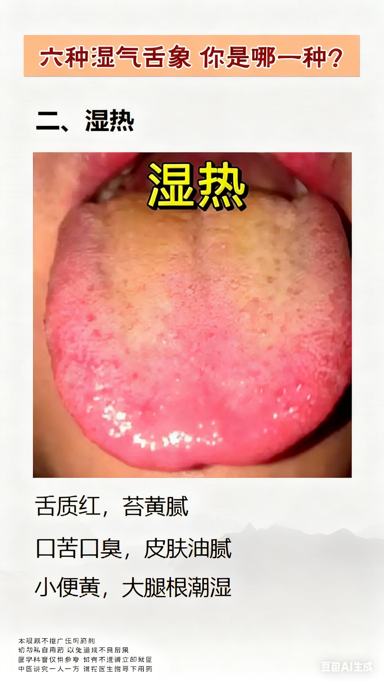 六种湿气舌象，你是哪一种？

在中医辨证中，湿气重是很常见的一种情况，但是细分的
