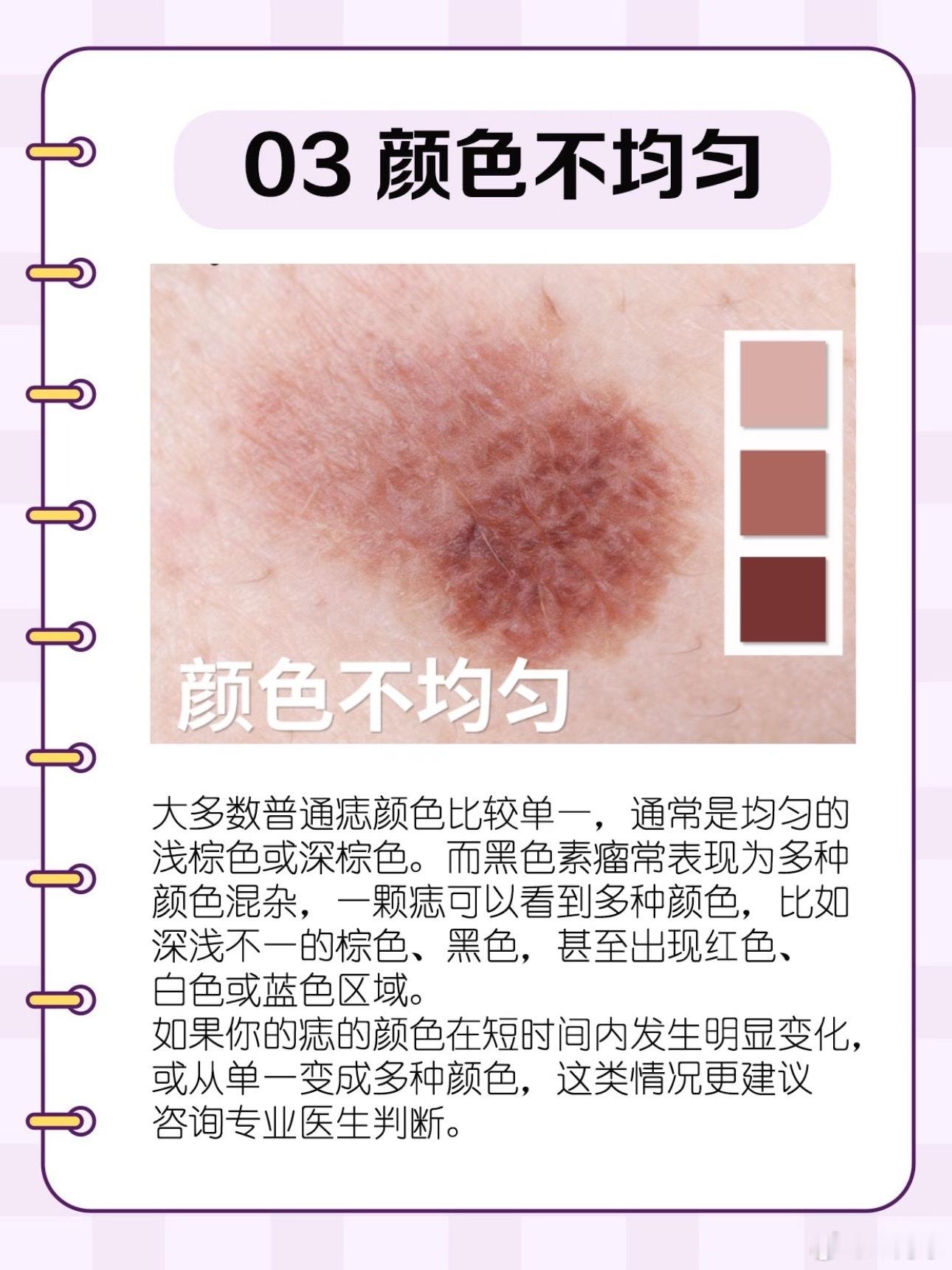 长这样的5种痣最容易癌变身上的痣不用过度恐慌，但这五类要格外留意：形状不对称、边