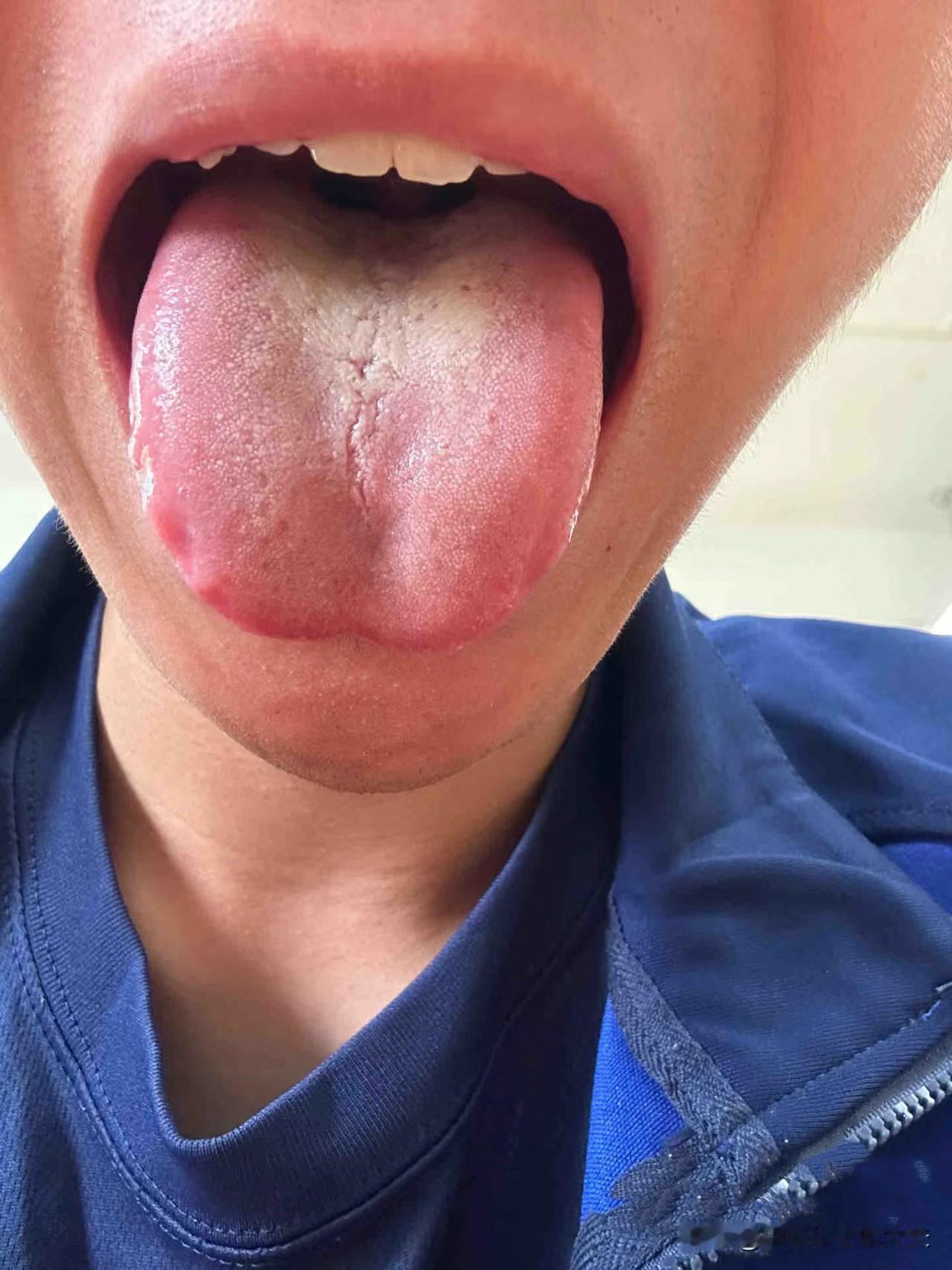 出现这样的舌象，把健脾丸，补肾丸都先放一放吧，现在真不是补虚的时候[泣不成声]
