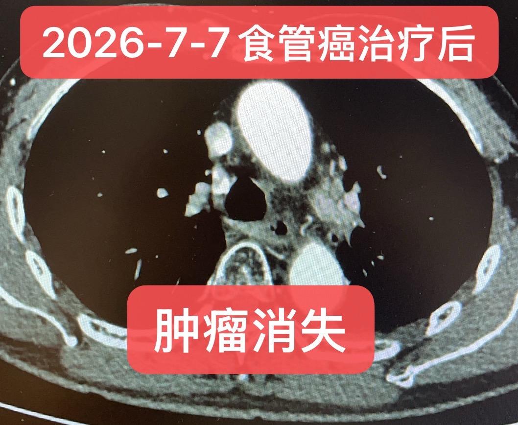 局部晚期食管癌的温和治疗。患者，男，75岁，2025年9月确诊食管鳞癌...