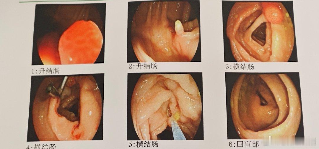 这种供血极为丰富的长蒂息肉，底部用钛夹封闭血供，再电切掉，是比较安全和效率很高的