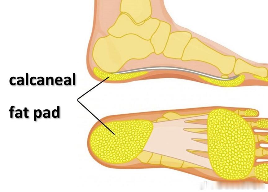 这种症状容易被误诊为足底筋膜炎 足底足跟疼痛，还有可能是「足跟脂肪垫综合征」足跟