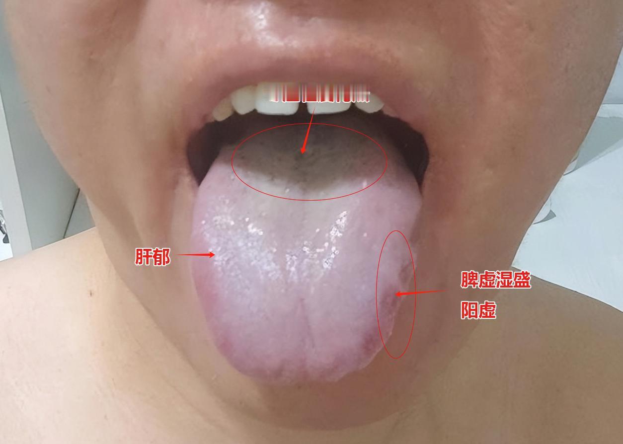 切记，看这个舌象虽然是脾虚，但是用参苓白术散，归脾健脾汤均无用！！
 
患者主诉