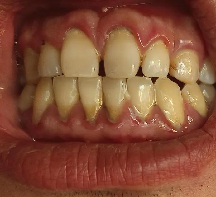 牙齿不太舒服，很久没去洗牙了，牙齿的牙龈都是肉白色的，是不是牙周炎啊，有了解的朋