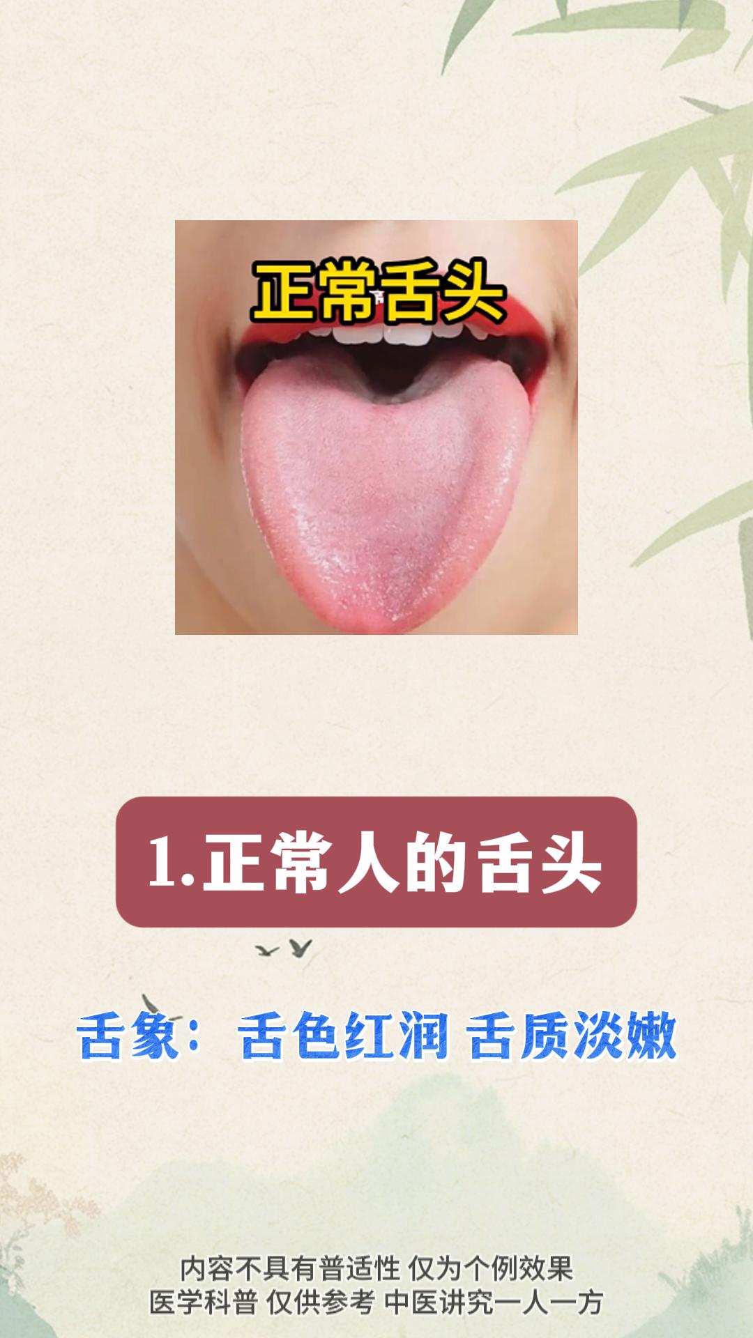 你的舌象正常吗？赶紧对照看看吧。