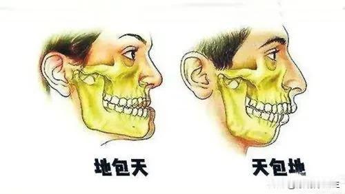 我们这里叫地包天，也被称为反颌畸形或兜齿，是一种常见的牙颌面发育性畸形。它指的是