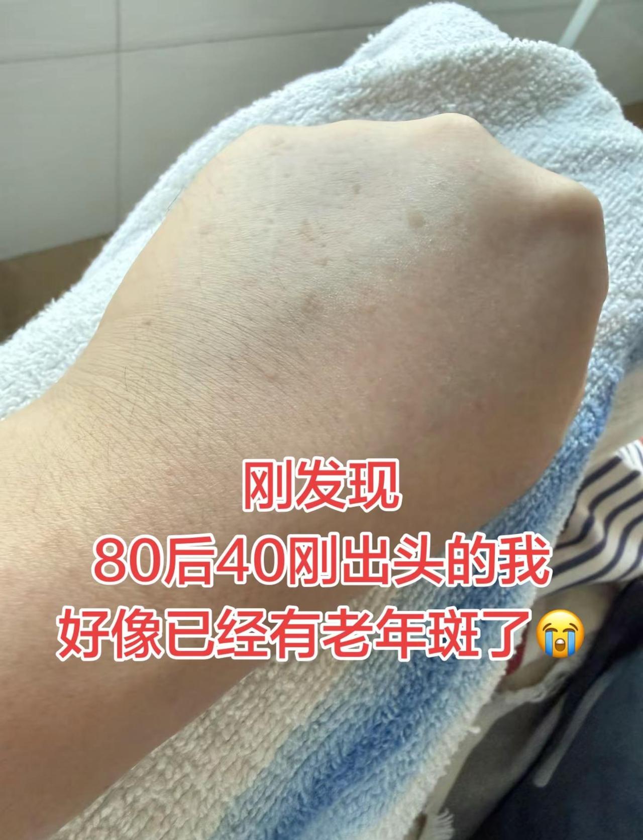 刚发现80后40刚出头的我好像已经有老年斑了😭！