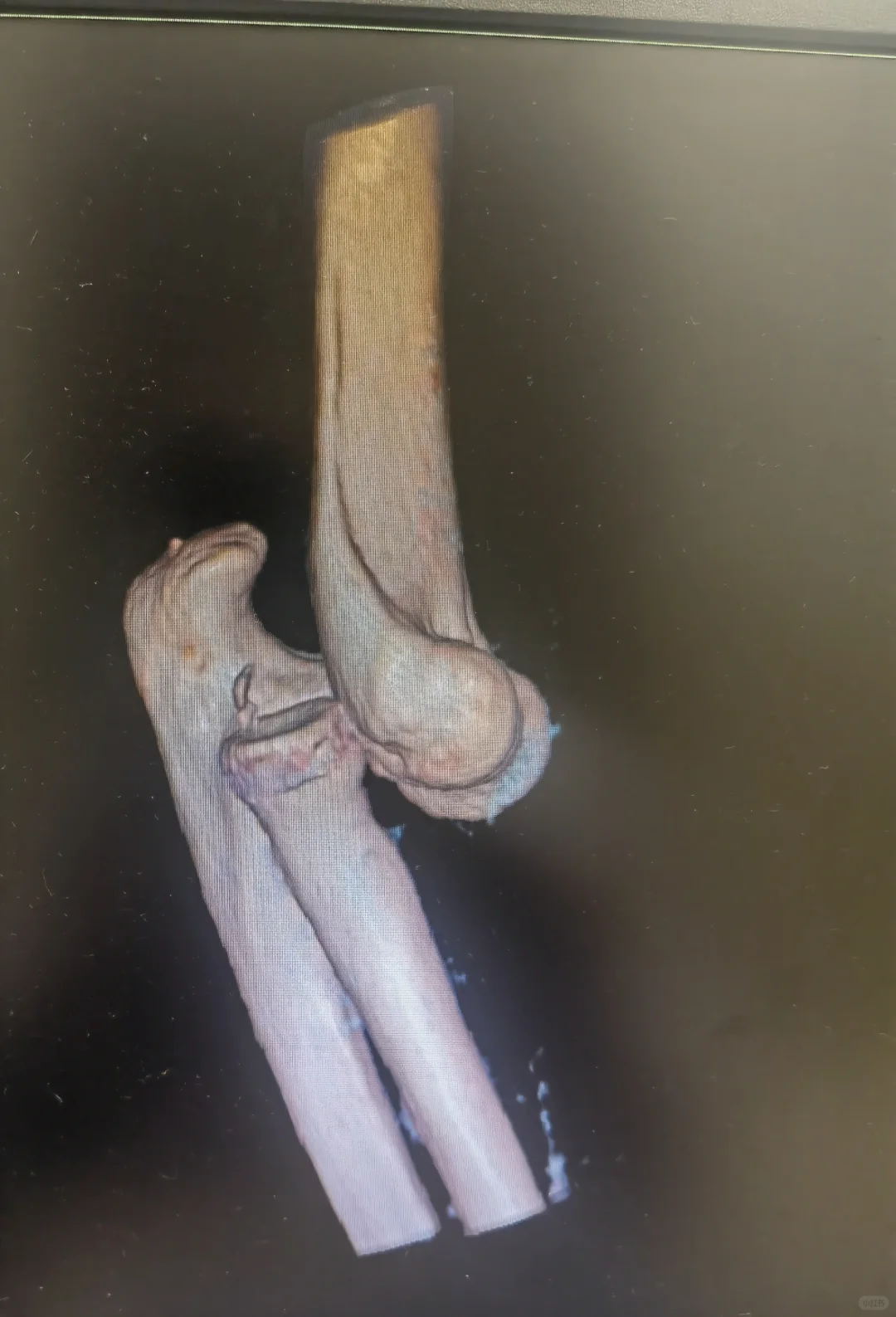 车祸导致肘关节疼痛，没想到是脱位