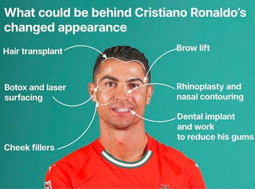 英媒曝40岁C罗或斥资180万整形，鼻部重塑成最明显痕迹据《每日邮报》报道，40