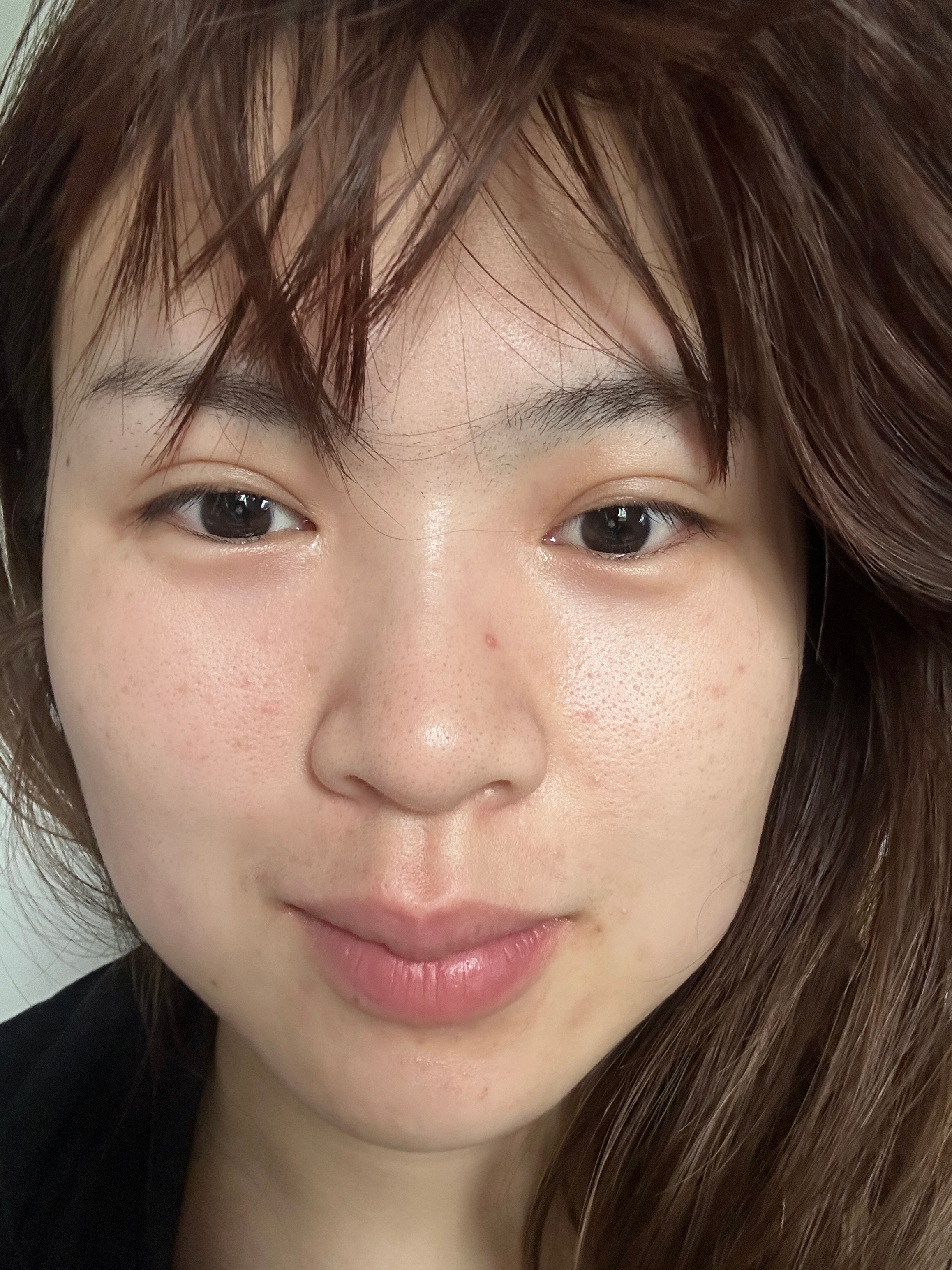 就让吃了螺狮粉的我肿成猪头 