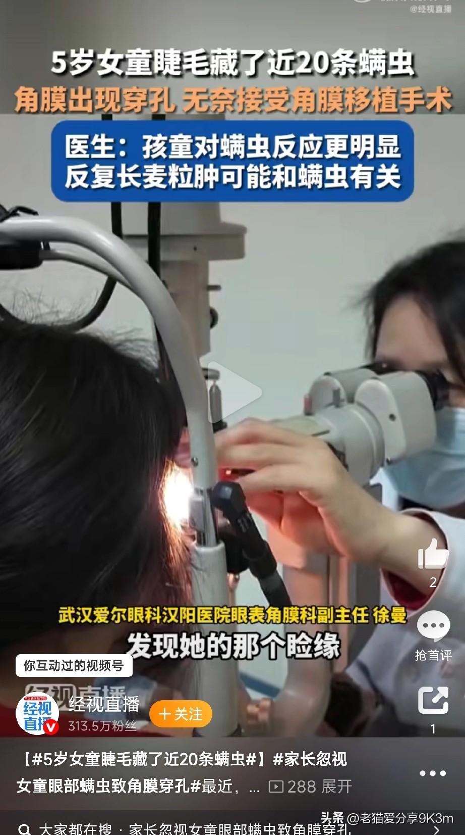 睫毛里藏了20条螨虫！

湖北荆门5岁女童小星，眼睛红肿流泪数月，家长竟没当回事