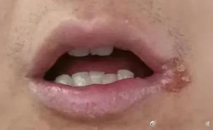 冬春季节，口角炎又悄悄地犯了。口角炎一般表现为单侧或者两侧的口角呈白色浸渍、起疱