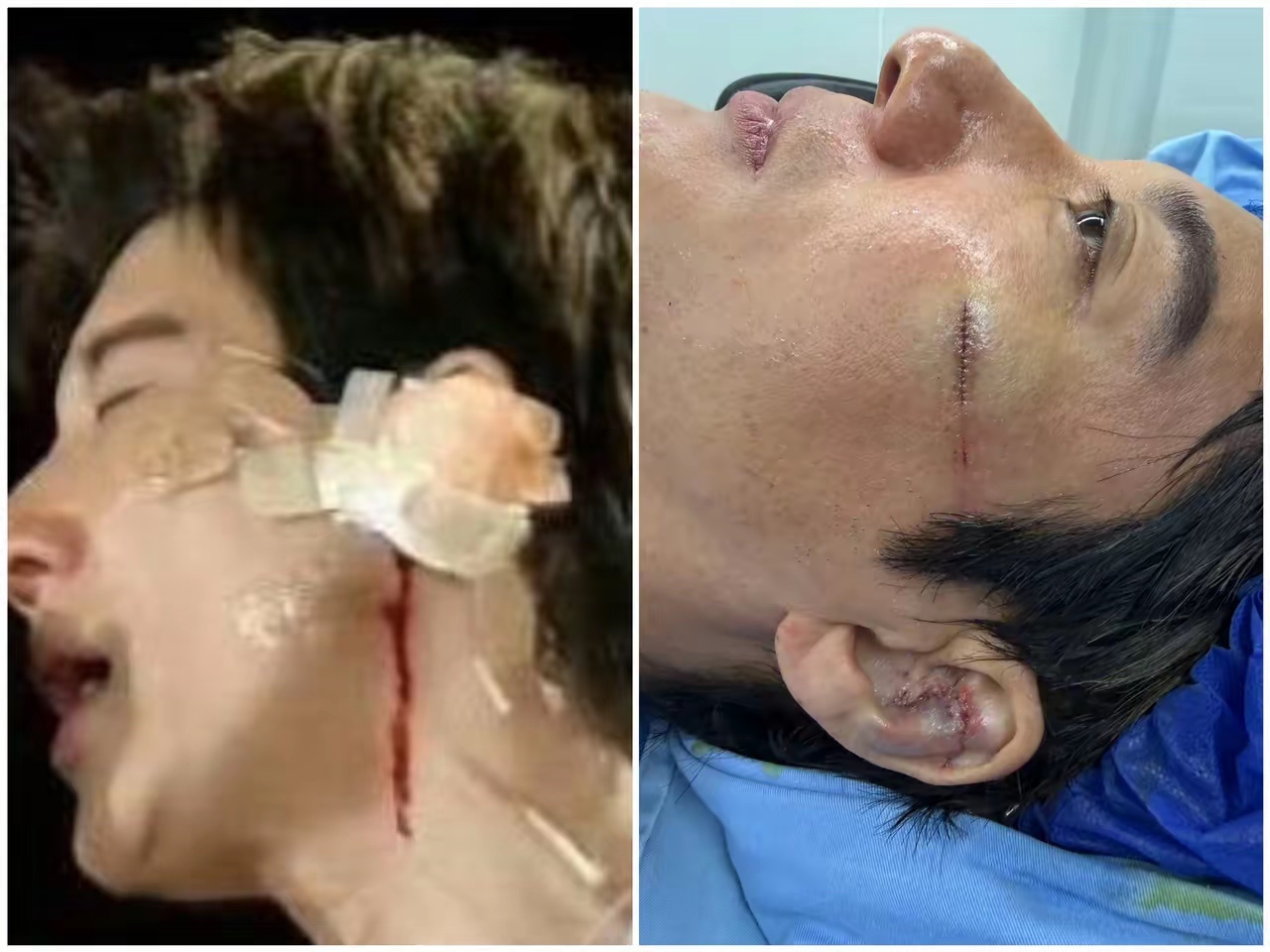 真是外行看热闹，内行看门道！我朋友是医生，他说王力宏演唱会绊倒磕伤耳朵，看着只是